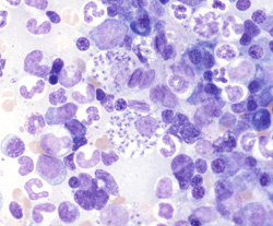 Leishmaniasis: Dog, bone marrow. The bone marrow contains hematopoietic precursors and macrophages with numerous intracytoplasmic Leishmania sp. organisms. The elongate organisms are distinguished by the central round dark basophilic kinetoplast structure.
