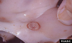 Lumpy Skin Disease: Bovine, nasal turbinate. The centers of well-developed pox are necrotic.