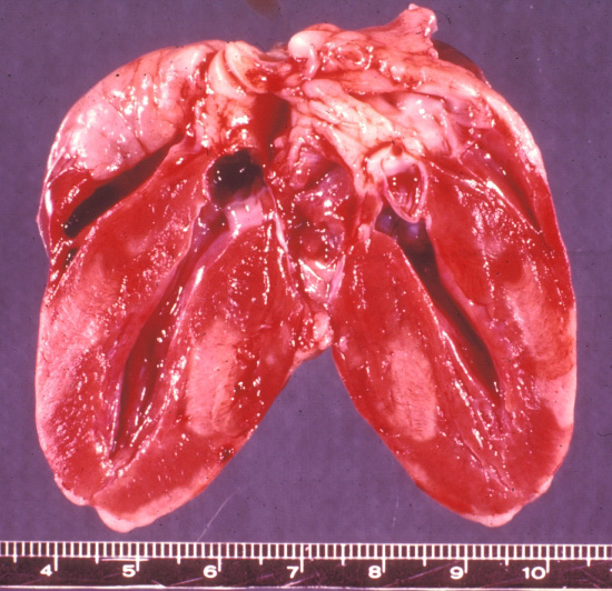 listeriosis: Ave, corazón.Hay múltiples focos pálidos de miocarditis purulenta.