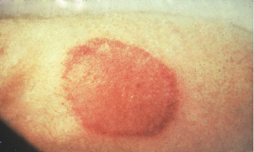 lyme-disease: Human, extremity, skin. Erythematous macule (erythema migrans) surrounded by an intense zone of hyperemia and/or hemorrhage.
