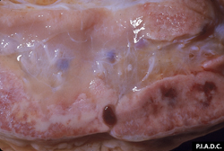 Fiebre Catarral Maligna: Bovino, ganglio linfático prescapular. Hay focos de hemorragia (y necrosis) en la corteza, y la médula esta edematosa.