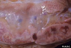 Malignant Catarrhal Fever: Bovine, prescapular lymph node. There are foci of hemorrhage (and necrosis) in the cortex, and the medulla is edematous. 