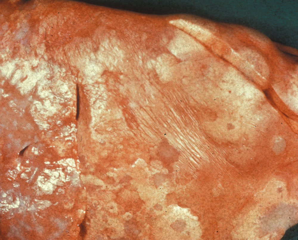 maedi-visna: Ovino, pulmón. El pulmón no colapsa y contiene áreas proliferativas grisáceas y pálidas que se unen (linfocitos y neumocitos proliferando)  con el parénquima adjacente con atelectasia y deprimido(rojo-rosado). 