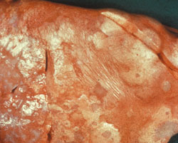 Maedi–visna: Ovino, pulmón. El pulmón no colapsa y contiene áreas proliferativas grisáceas y pálidas que se unen (linfocitos y neumocitos proliferando)  con el parénquima adjacente con atelectasia y deprimido(rojo-rosado). 