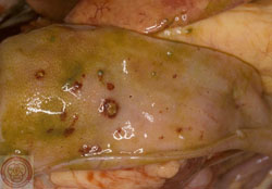 Newcastle Disease: Avian, colon. The mucosa contains multiple sharply demarcated foci of hemorrhage and necrosis.