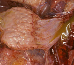 Maladie de Newcastle : Volaille, proventricule. La muqueuse proximale est érodée et recouverte d'une membrane fibrino-nécrotique (diphtérique).