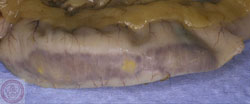Maladie de Newcastle : Volaille, nécrose intestinale segmentaire de la muqueuse.
