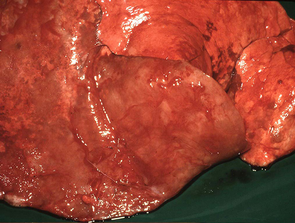 ovine-pulmonary-adenocarcinoma: Ovino, pulmón. Los pulmones están sin colapsar y tienen una apariencia moteada con áreas proliferativas coalescentes a difusas (rosa pálido), con áreas rojas de atelectasis. 