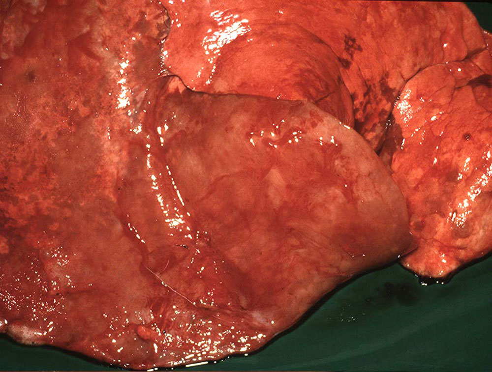 ovine-pulmonary-adenocarcinoma: Sheep, lung. The lungs fail to deflate and are mottled with coalescing to diffuse proliferative areas (pale pink) with red areas of atelectasis.