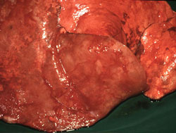 Adenomatosis Pulmonar Ovina: Ovino, pulmón. Los pulmones están sin colapsar y tienen una apariencia moteada con áreas proliferativas coalescentes a difusas (rosa pálido), con áreas rojas de atelectasis. 
