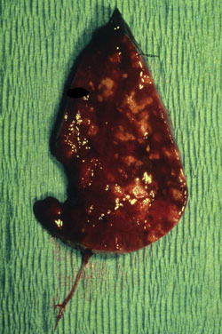 Peste: Primate, hígado. El hígado esta agrandado y tiene lesiones blancas multifocales y coalescentes debido a una infección por Yersinia pestis. 