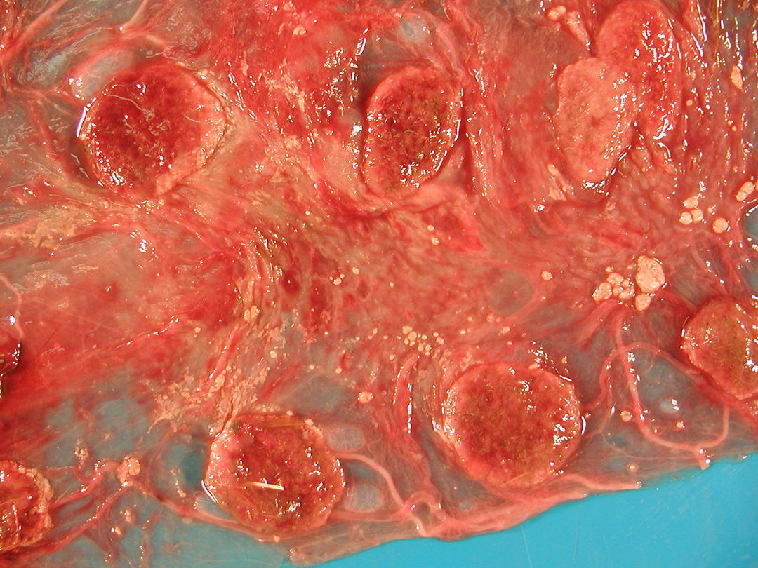 q-fever: Caprino, placenta. La placenta intercotiledonaria esta engrosada, opaca y está multifocalmente cubierta con exudado. Los márgenes de varios cotiledones tienen un color marrón  claro (necrosis) y los centros están moteados rojo-amarronados (congestión y exudación). 