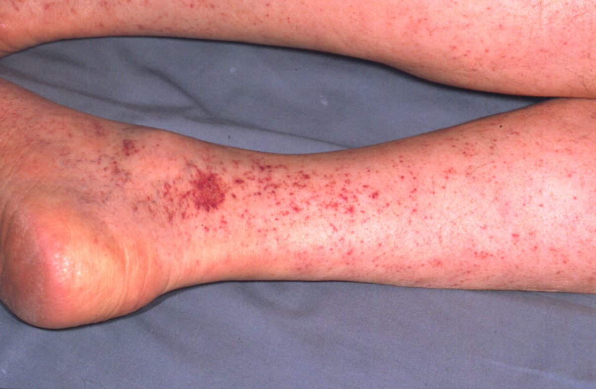 rocky-mountain-spotted-fever: Human, legs. Disseminated cutaneous petechiae coalesce in two foci to form ecchymoses. 