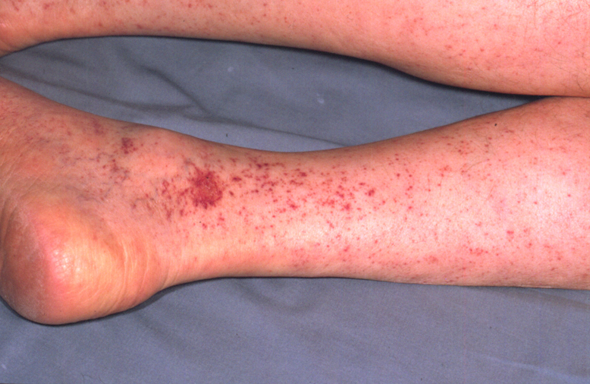 rocky-mountain-spotted-fever: Pierna, humana. Petequias cutáneas diseminadas se unen para formar una equimosis.