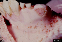 Rinderpest: Bovine, oral mucosa. There are numerous small gingival erosions.