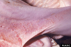 Rinderpest: Bovine, oral mucosa. There are numerous coalescing erosions on the ventrolateral lingual mucosa.