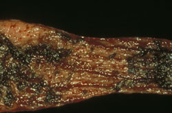 Rinderpest: Bovine, intestine. Erosions with ulceration; dark areas of mucosal necrosis and hemorrhage.