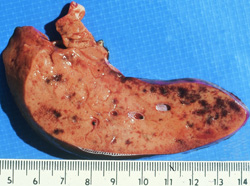 Rift Valley Fever: Sheep, liver. Section reveals that the liver is pale, swollen and contains multiple foci of hemorrhage.