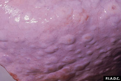 Clavelée et variole caprine: Petits ruminants,  poumon. Nombreux nodules pâles surélevés (pneumonie multifocale).