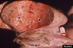 Viruela Ovina y Caprina: Caprino, pulmón. Hay múltiples focos de consolidación (neumonía) coalescentes con coloración marrón claro, y el ganglio linfático adyacente esta marcadamente agrandado.