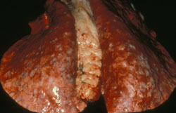Viruela Ovina y Caprina: Ovino, pulmones. Con nódulos granulomatosos difusos.