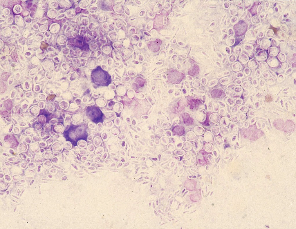 sporotrichosis: Cat, skin, cytologic imprint. There are numerous oval to "cigar-shaped" yeast-like thin-walled organisms consistent with Sporotrix schenckii.