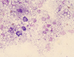 Sporotrichosis: Cat, skin, cytologic imprint. There are numerous oval to "cigar-shaped" yeast-like thin-walled organisms consistent with Sporotrix schenckii.