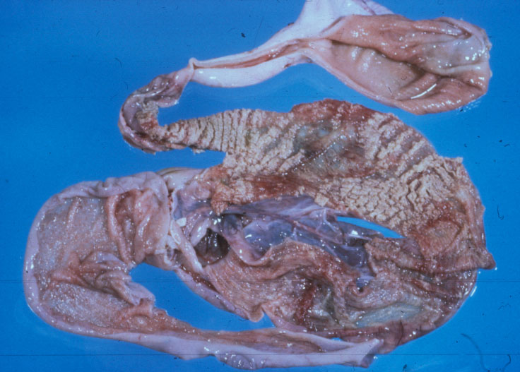 salmonella-reptile: Tortoise, intestinal tract. Enteritis with white raised roughened folds/ridges of fibrous exudate forming a diphtheritic membrane over the mucosal surface and a few focal areas of reddened erosions.