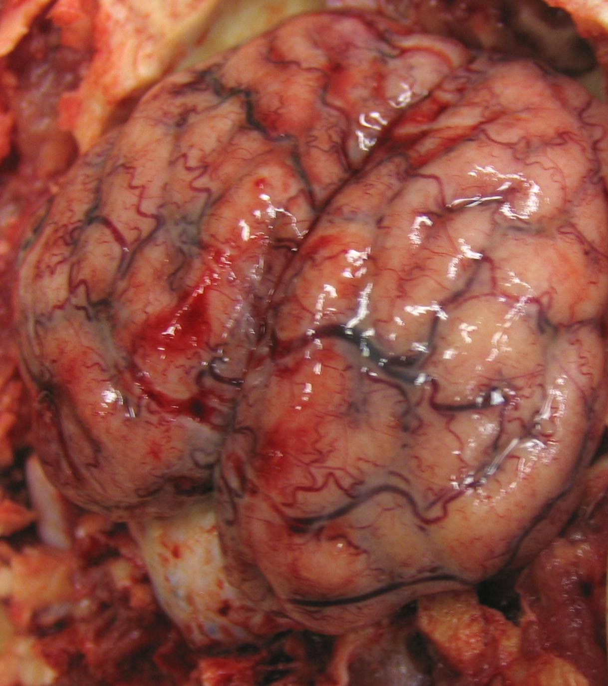 streptococcosis: Pig, brain. Leptomeninges over the cerebral hemispheres are severely congested and contain foci of hemorrhage; the underlying gyri are flattened, and some sulci are cloudy due to the presence of purulent exudate (meningitis caused by Strep suis).