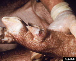 Swine Vesicular Disease: Pig, foot. The wall of the dewclaw is undermined adjacent to an ulcer at the coronary band.