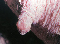 Swine Vesicular Disease: Pig, skin. There are coalescing erosions on the teat.