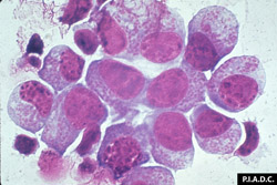 Theileriosis: Bovine lymphoblasts contain intracytoplasmic Theileria parva.