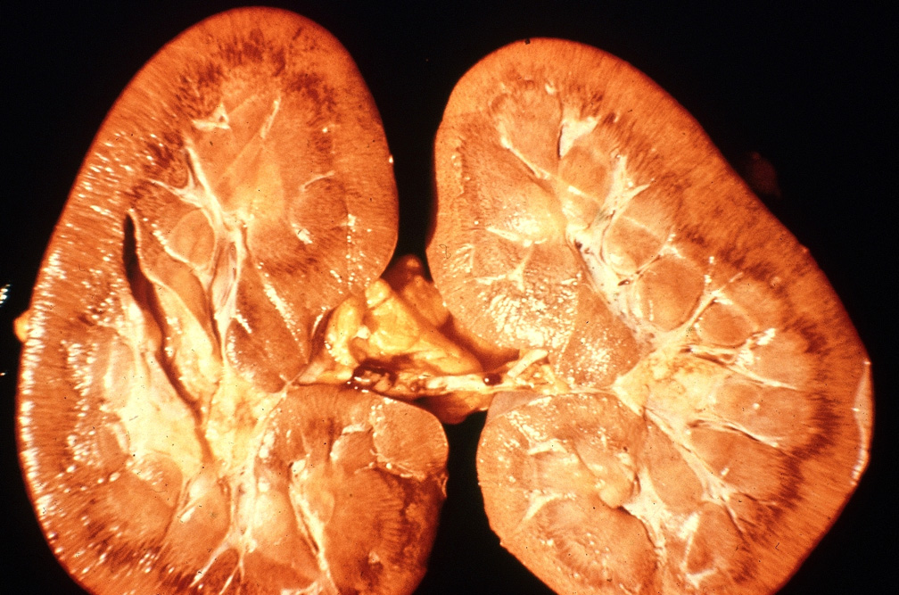 trypanosomiasis-african: Horse, kidney. Cortex is pale and there are multiple petechial hemorrhages at the corticomedullary junction.