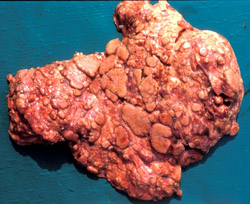 Tuberculosis Bovina: Bovino, Pulmón. El parénquima del pulmón ha sido casi enteramente remplazado por nódulos pálidos sobre elevados de varios tamaños que se unen.
