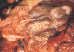 Bovine Tuberculosis: Pig, tracheobronchial lymph nodes. The center of the sectioned node is replaced by caseous, mineralized debris. 