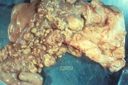 Tuberculosis Bovina: Bovino, útero. El endometrio contiene varios tubérculos elevados. 