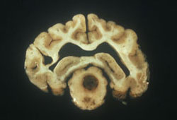 Toxoplasmosis: Dog, brain. Mesencephalon of the brain with a centralized brown round lesion of encephalomalacia and necrosis, and ventrally located smaller similar lesions.