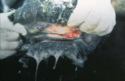 Vesicular Stomatitis: Bovine, oral. There is extensive ulceration of the dental pad, and severe salivation. 